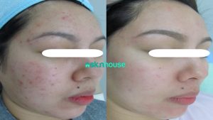 Revlite for Treatment of Acne and SCars