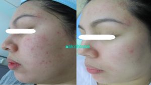Revlite for Treatment of Acne and SCars 1
